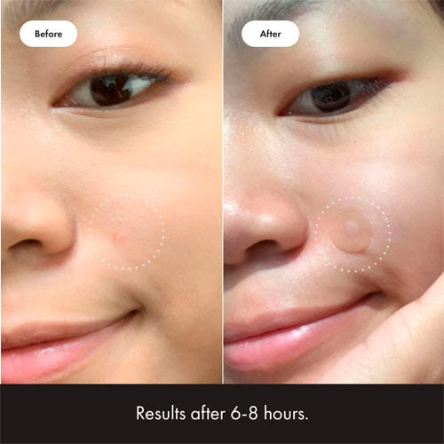 Hydrocolloid Acne Patch to Cover Pimples and Blemishes